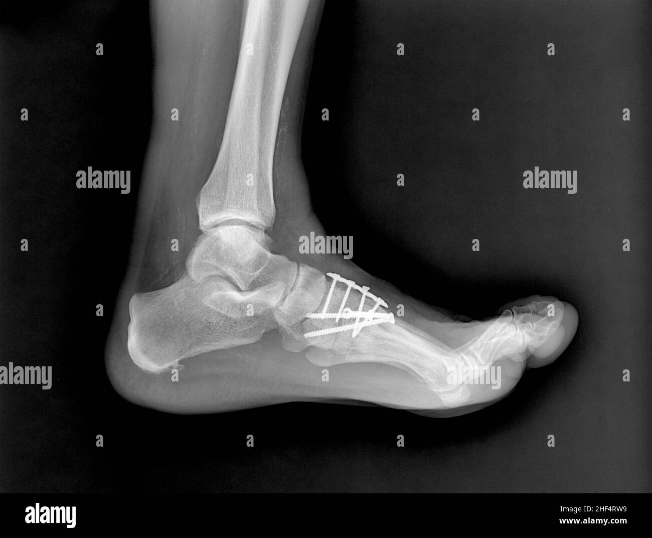 Radiografía de un pie operado, después de un traumatismo, en proyección