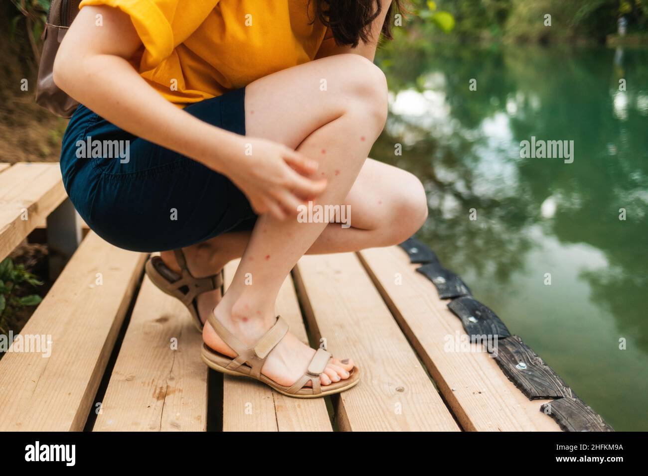 Picaduras de mosquitos. Una mujer en cuclillas, rascándose las piernas  picadas con sus manos. Piernas en un primer plano de erupción roja. Parque  de verano y río en el fondo Fotografía de