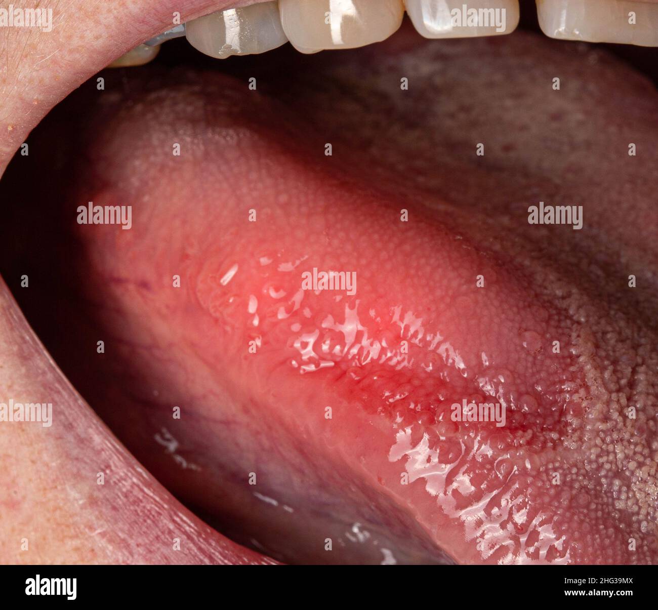 Enfermedad inflamatoria en la lengua. Punto rojo, glositis. Higiene de