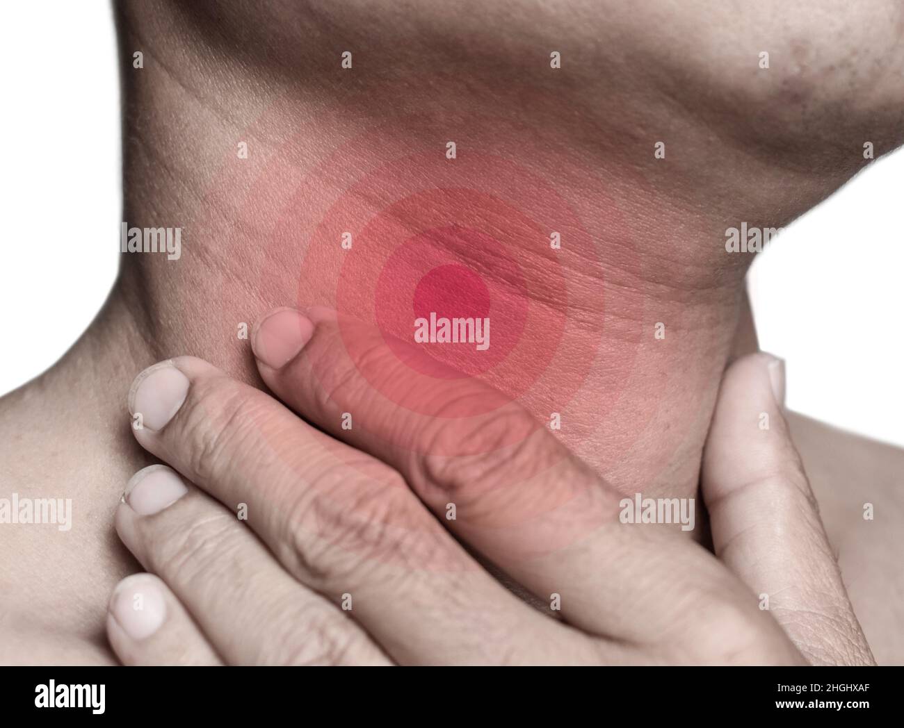Enrojecimiento en el cuello de Asia, Myanmar hombre. Concepto de dolor de garganta, faringitis, laringitis o disfagia. Foto de stock