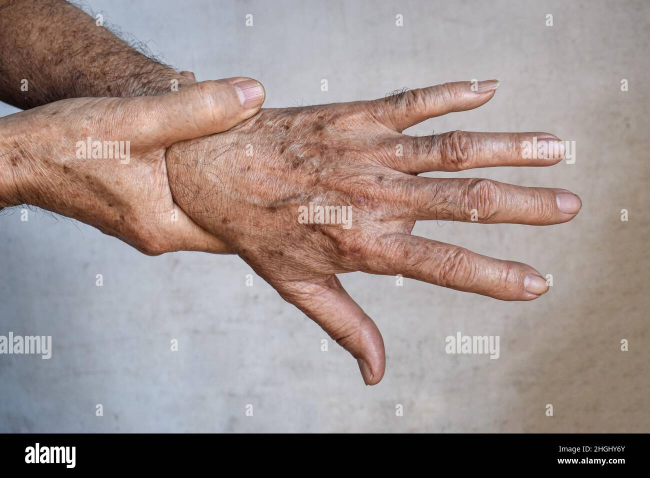 Manchas de edad en manos del anciano asiático. Son manchas marrones, grises o negras y también se llaman manchas hepáticas, lentejas lentiginas solares manchas solares Fotografía de stock -