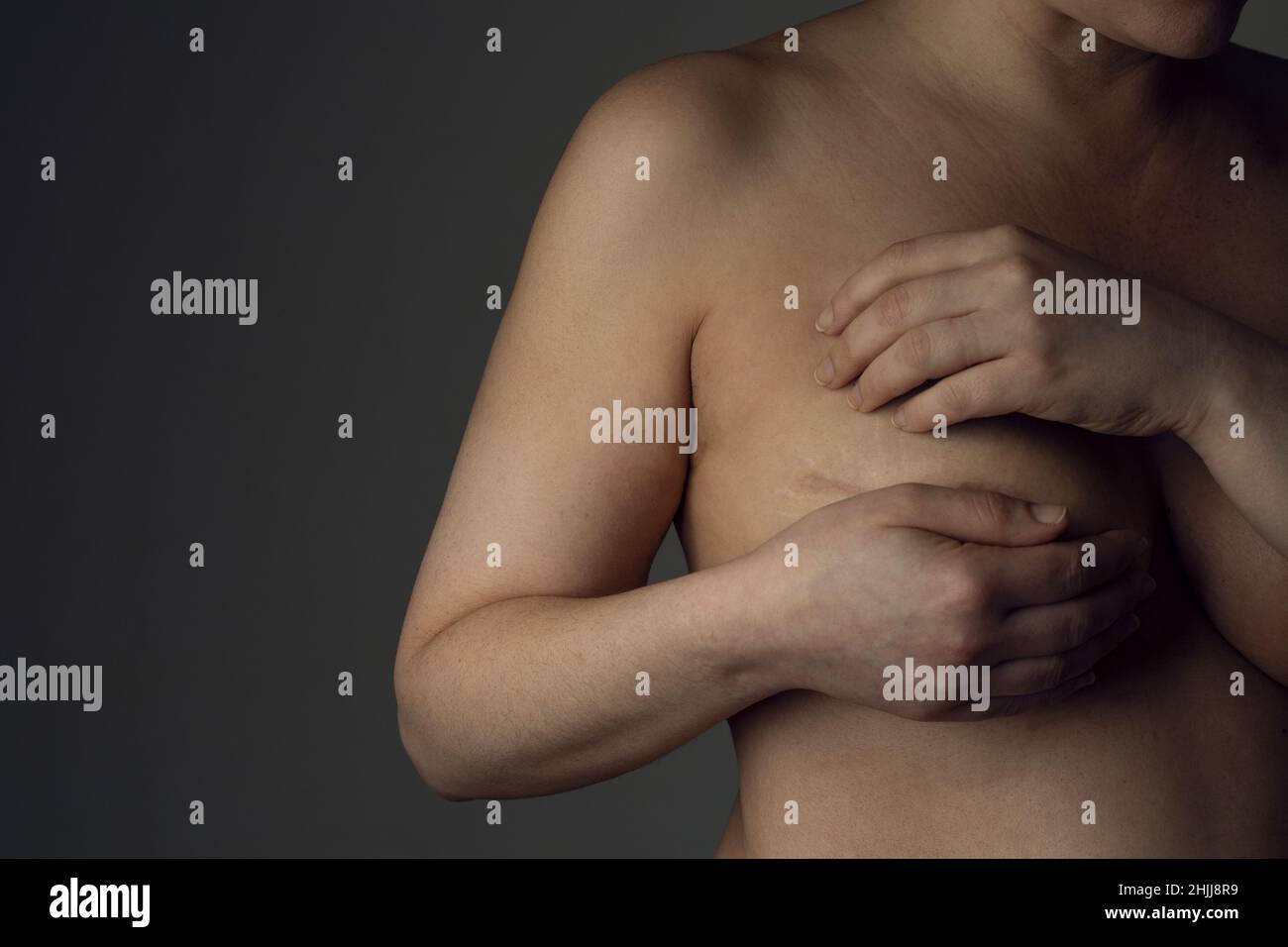 La mujer sobreviviente de cáncer de mama muestra la cicatriz en su pecho después de una mastectomía Fotografía de stock foto imagen
