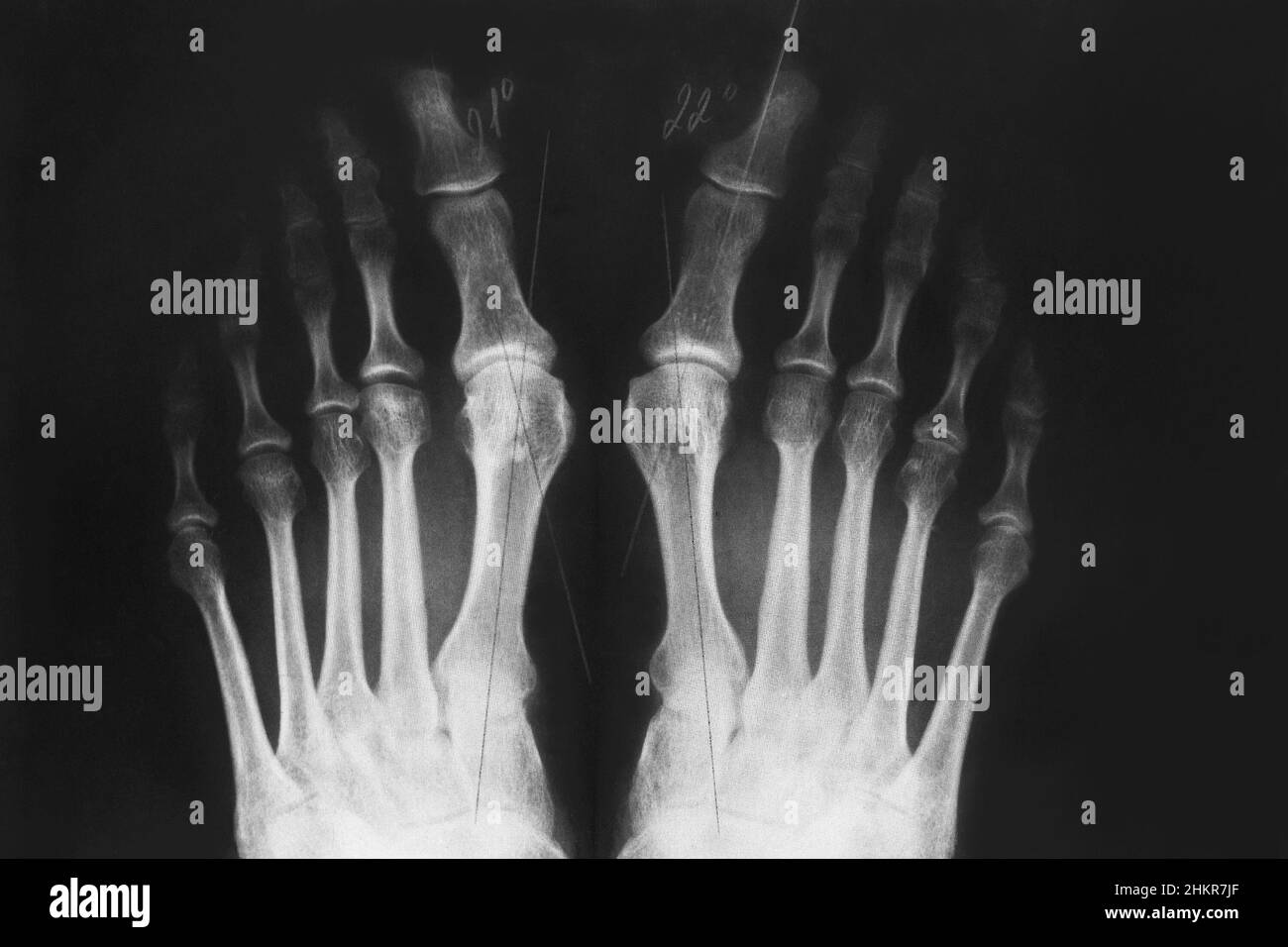 Radiografía de los pies, deformidad del pie del valgo o hueso en un dedo, 3rd grados. Enfermedad ortopédica. Foto de stock