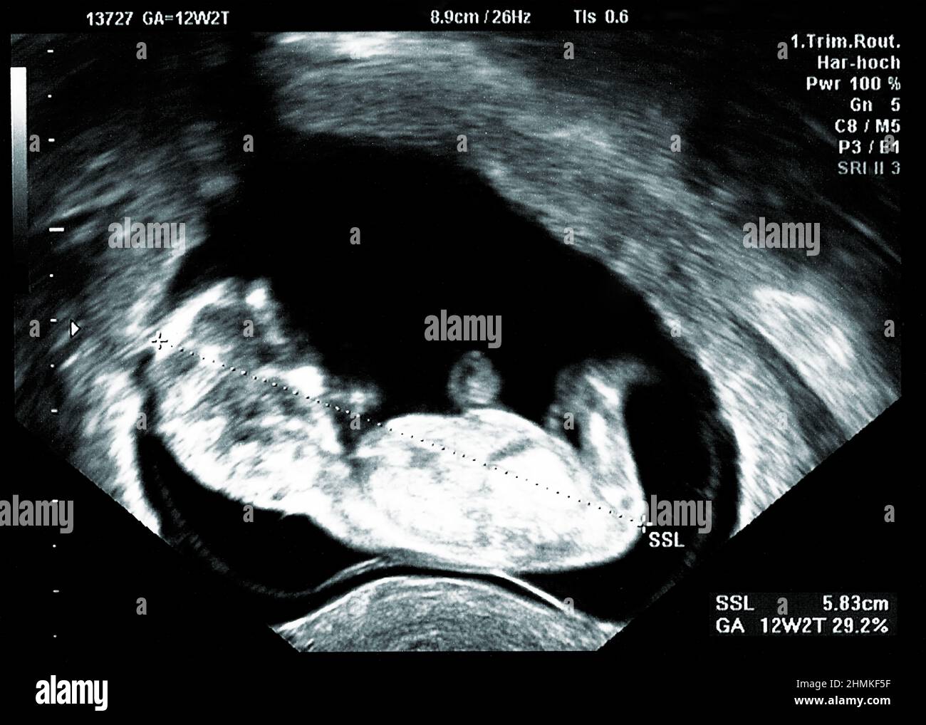 Ultrasonido bebé pequeño a las 12 semanas. La imagen ecográfica de 12  semanas de embarazo muestra