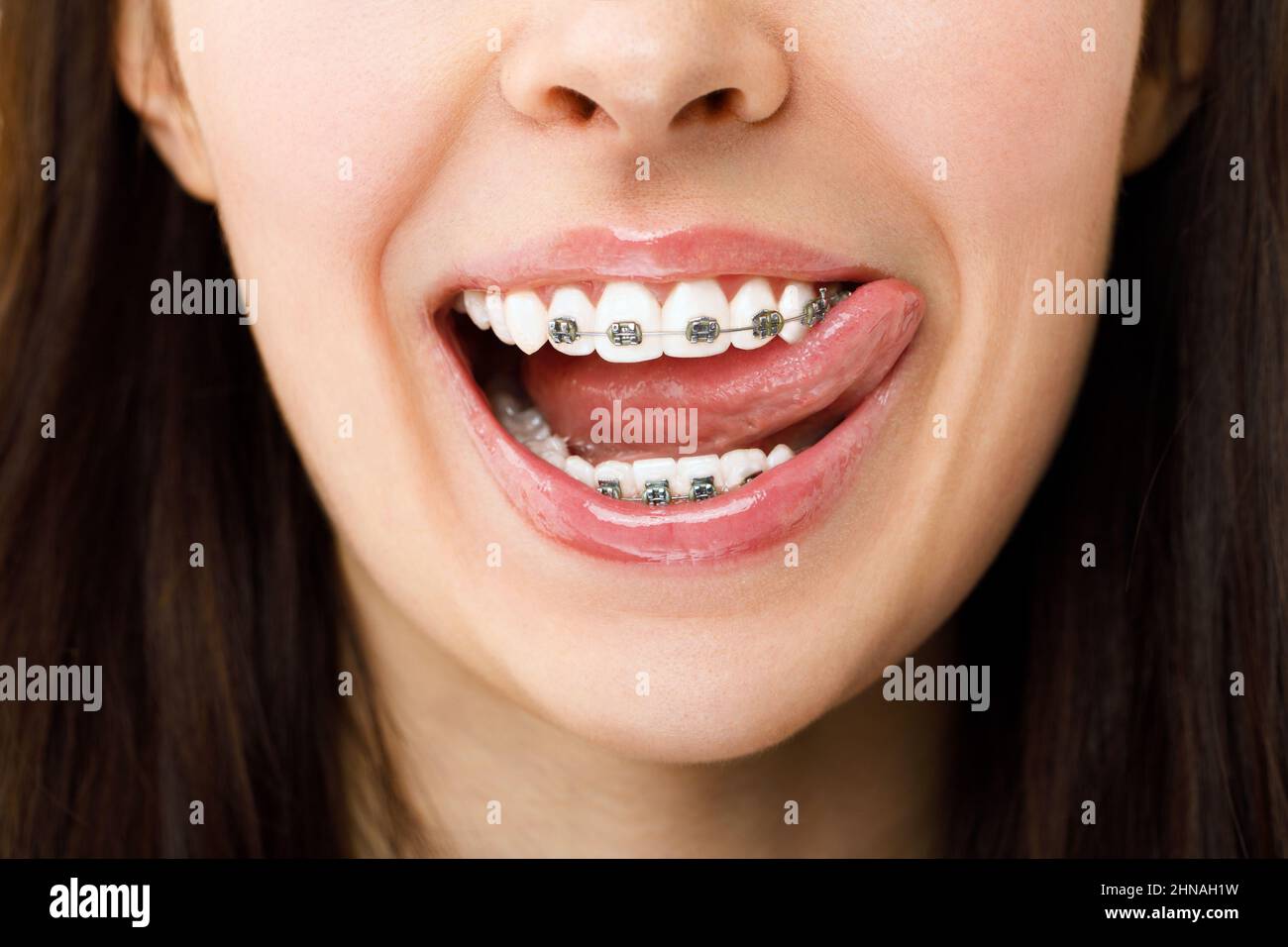 El tratamiento ortodóncico. Concepto de cuidado dental. Mujer hermosa sonrisa saludable de cerca. Closeup cerámica y soportes de metal en los dientes. Hermosa hembra Foto de stock