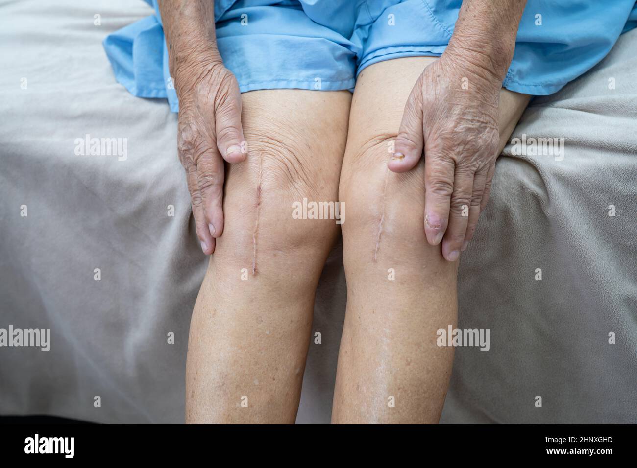 Paciente mujer mayor asiática muestra sus cicatrices en la articulación de la  rodilla 3044617 Foto de stock en Vecteezy