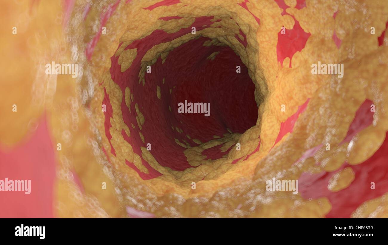 Arteria humana grasos, ilustración. Foto de stock
