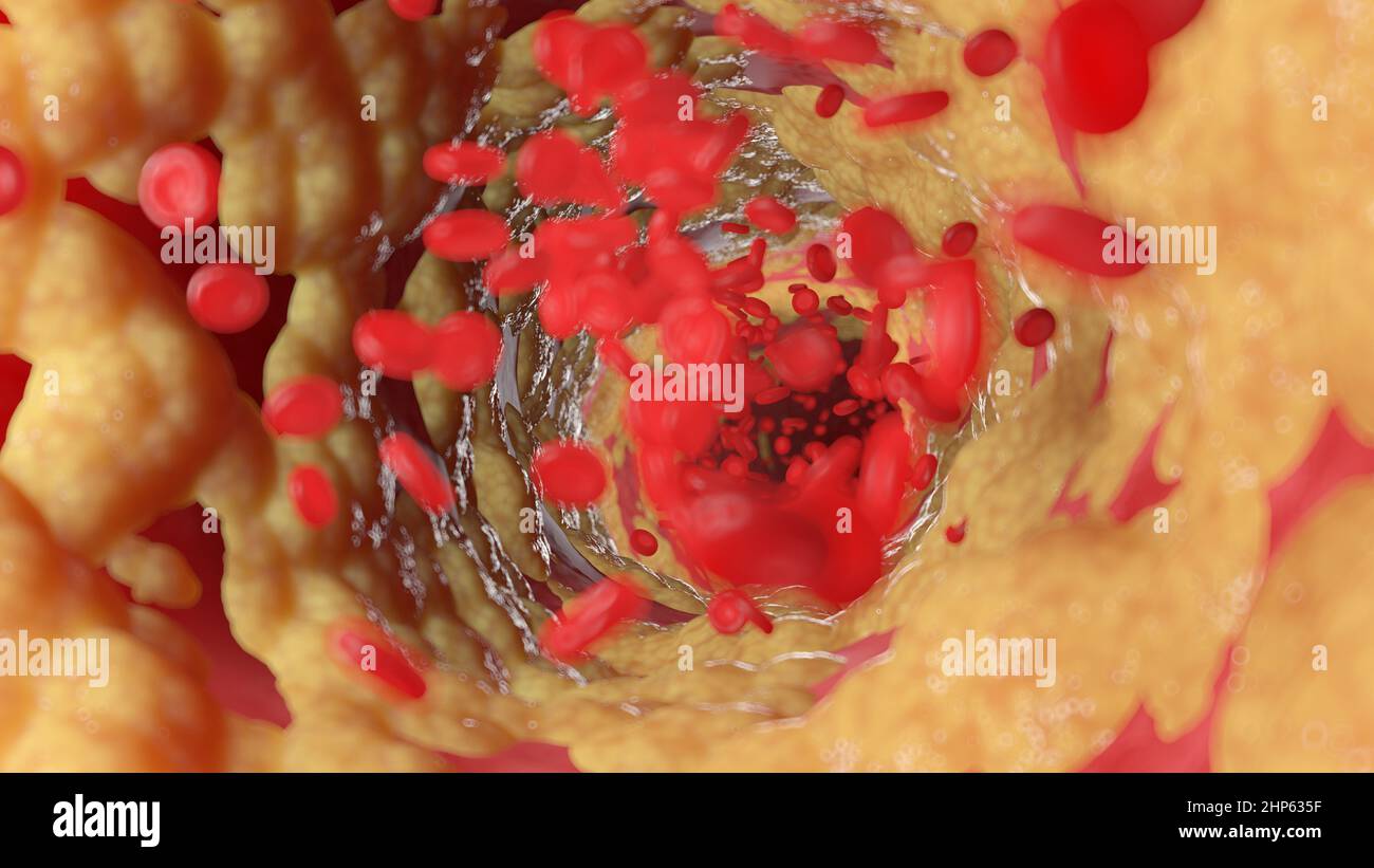 Arteria humana grasos, ilustración. Foto de stock