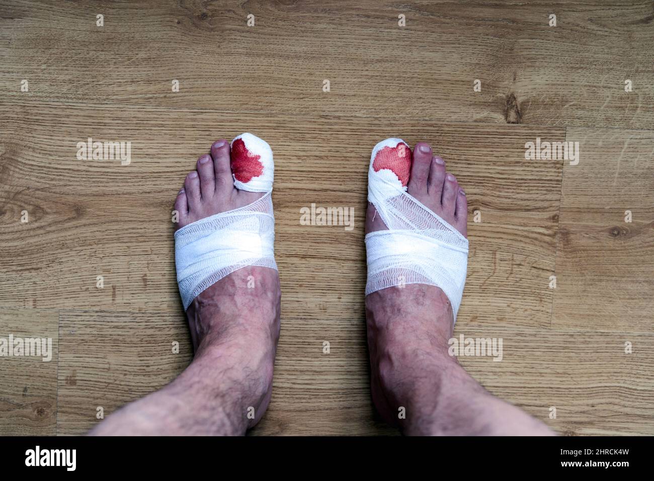 Las piernas de un hombre con sangre vendaron los dedos de los pies grandes de pie en el suelo Foto de stock