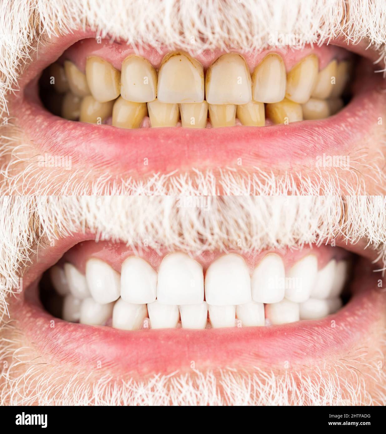 Dientes masculinos antes y después del blanqueamiento, odontología de  cuidado oral, estomatología. Sonriente hombre antes y después del  procedimiento de blanqueamiento dental, primer plano. Primer plano de  Fotografía de stock - Alamy