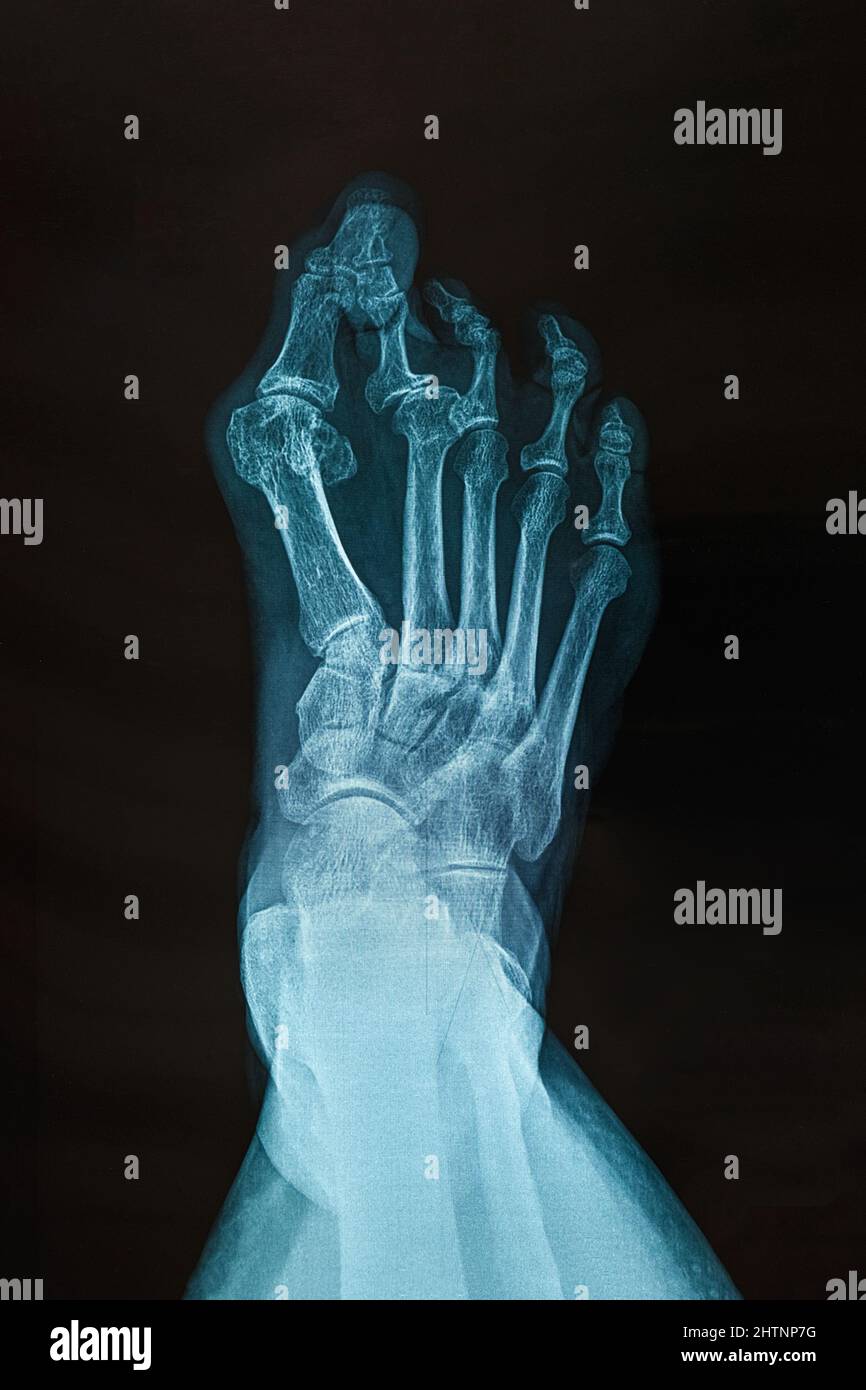 Radiografía del pie derecho. Desviación transversal del plano, deformación cruzada del segundo dedo del pie. Deformidad del plano transversal con subluxación medial del segundo Foto de stock