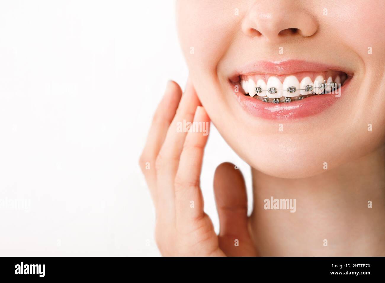 Sonría con los cordones Tratamiento anatómico. Concepto de cuidado dental. Hermosa Mujer Sana Sonrisa de cerca. Cierre de abrazaderas cerámicas y metálicas en los dientes Foto de stock