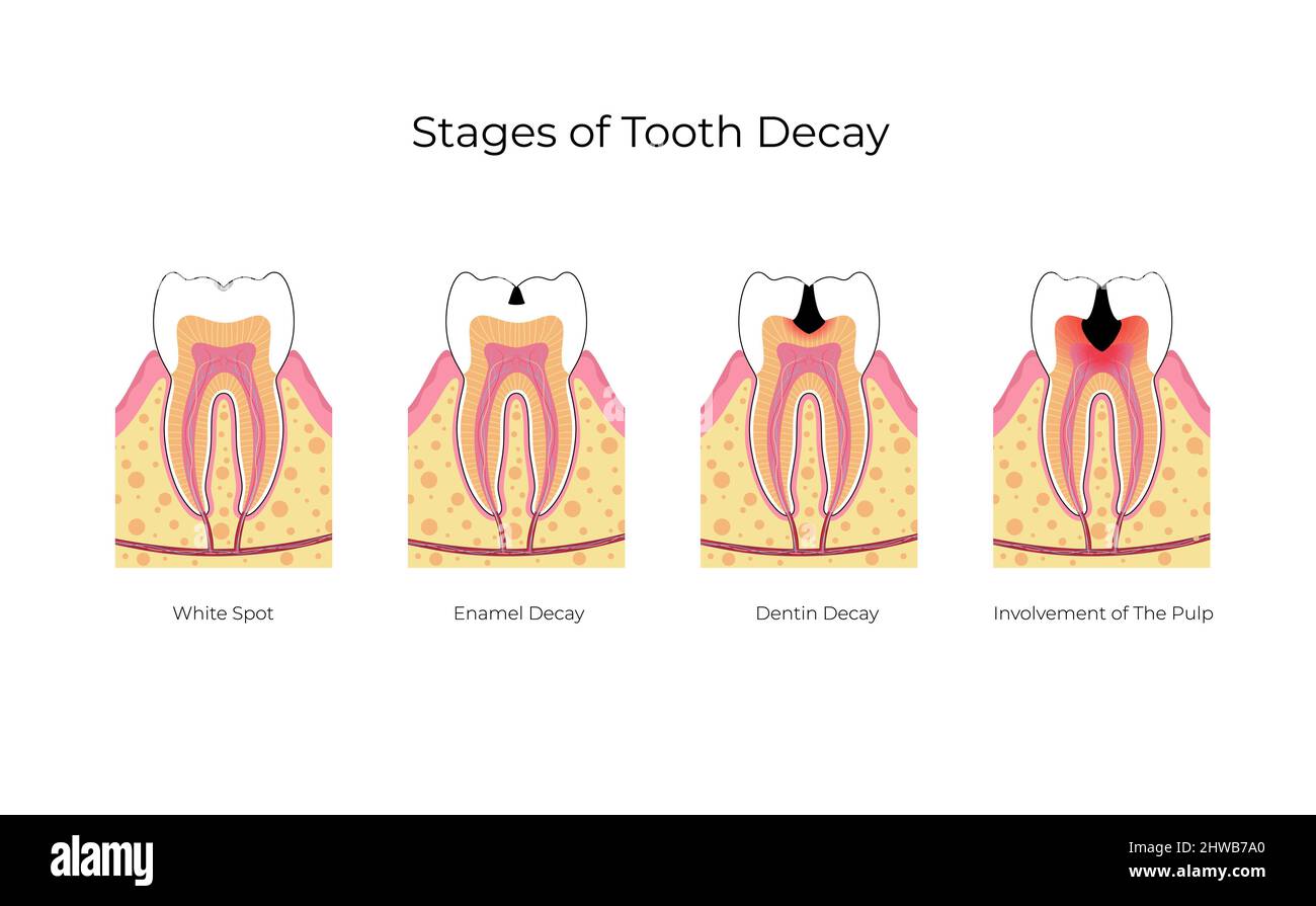 Etapas de la caries dental fotografías e imágenes de alta resolución
