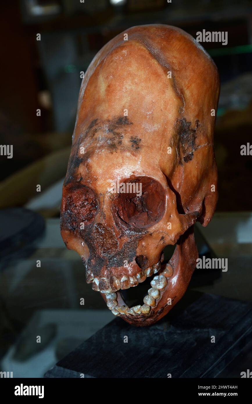 La deformación intencional del cráneo se realizó en culturas antiguas alrededor del mundo. Se hizo en los bebés por razones sociales por las culturas antiguas. Foto de stock