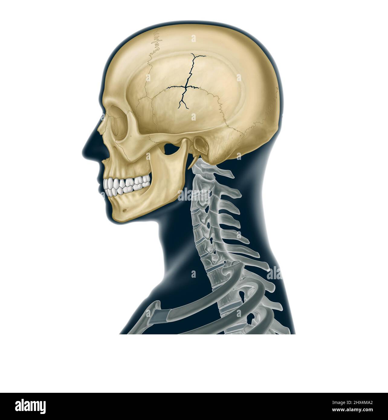 Fractura del cráneo Foto de stock