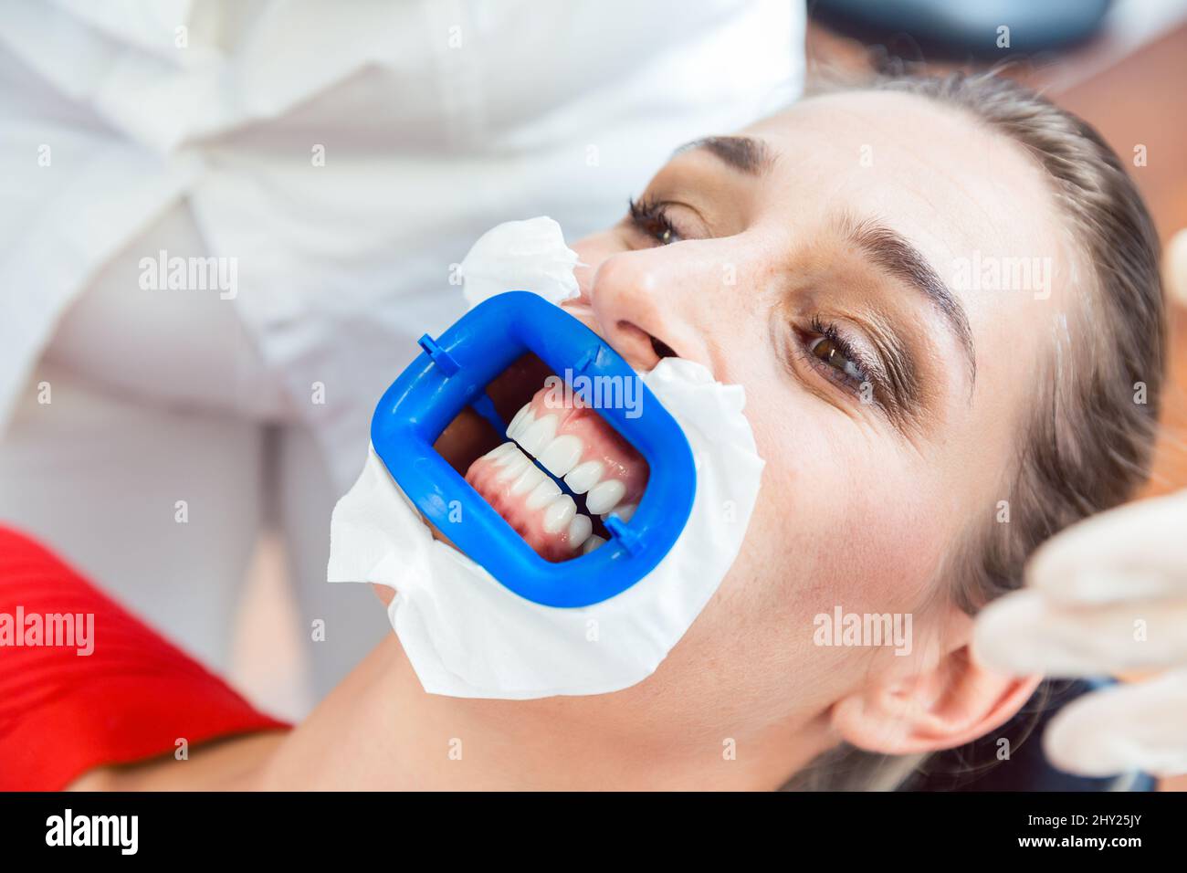 Paciente femenino sometido a un procedimiento de blanqueamiento dental Foto de stock