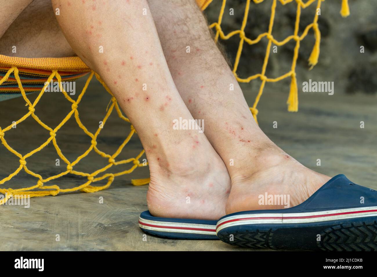 Las piernas picadas por insectos sedientos de sangre, picaduras de  mosquitos, mosca de la arena, pulgas de arena o moscas tropicales llamadas  puri puri, el problema de la gente que gasta el