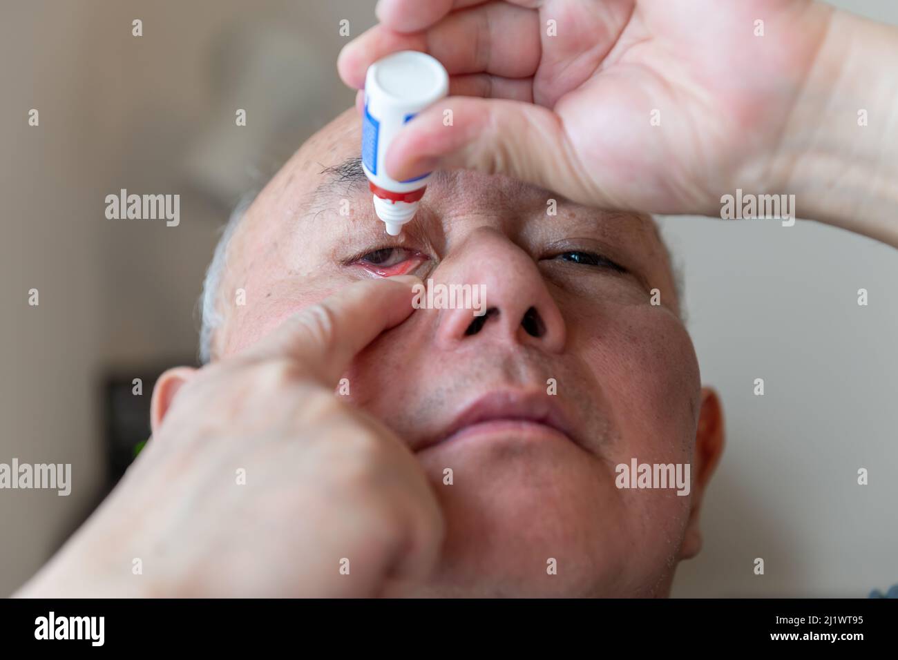 Un hombre que aplica gotas oculares antibacterianas a un ojo rojo infectado. Foto de stock
