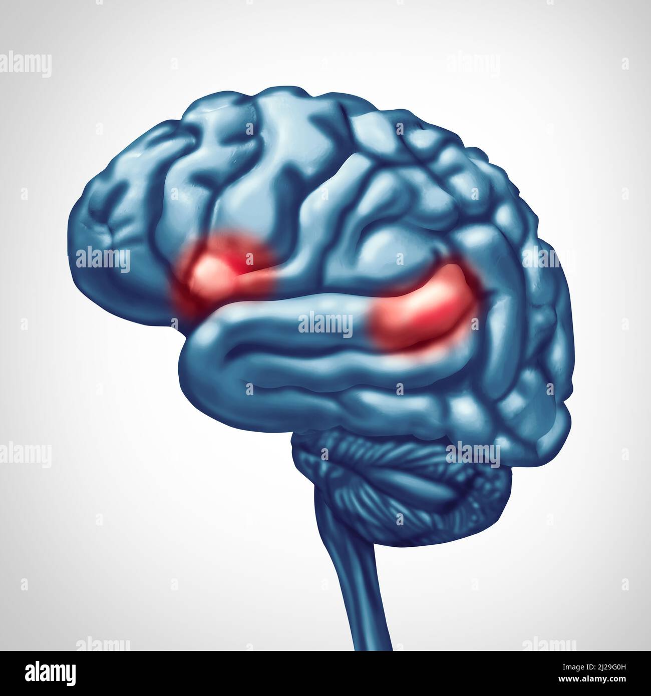 Afasia concepto de trastorno cerebral como daño a la enfermedad mental humana que resulta en problemas con el habla y la capacidad del lenguaje. Foto de stock