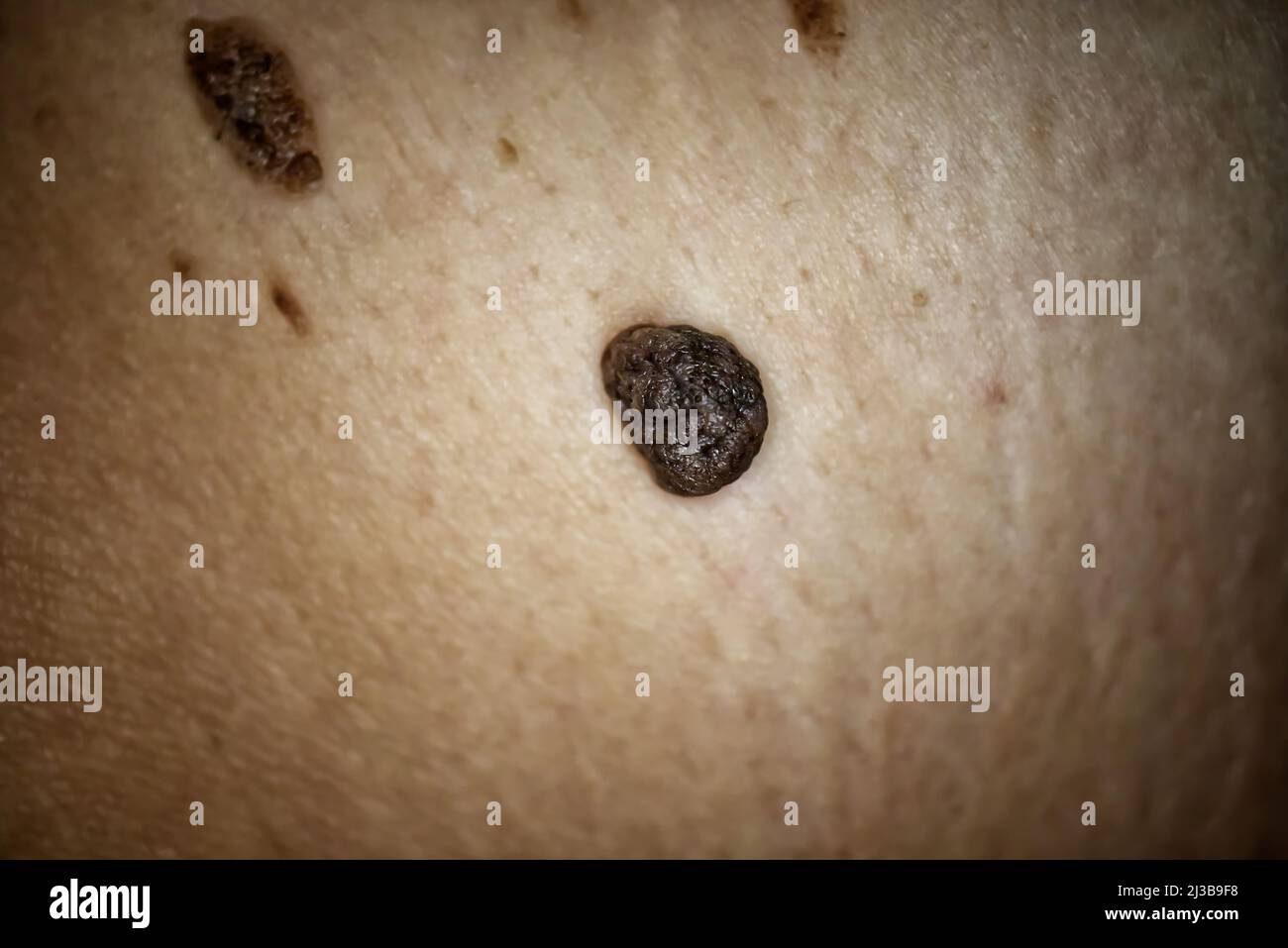 Moretón Brote Prestigio Un lunar grande o melanoma en la parte posterior de una mujer. Pigmentación  en la espalda. Foto médica de salud Fotografía de stock - Alamy