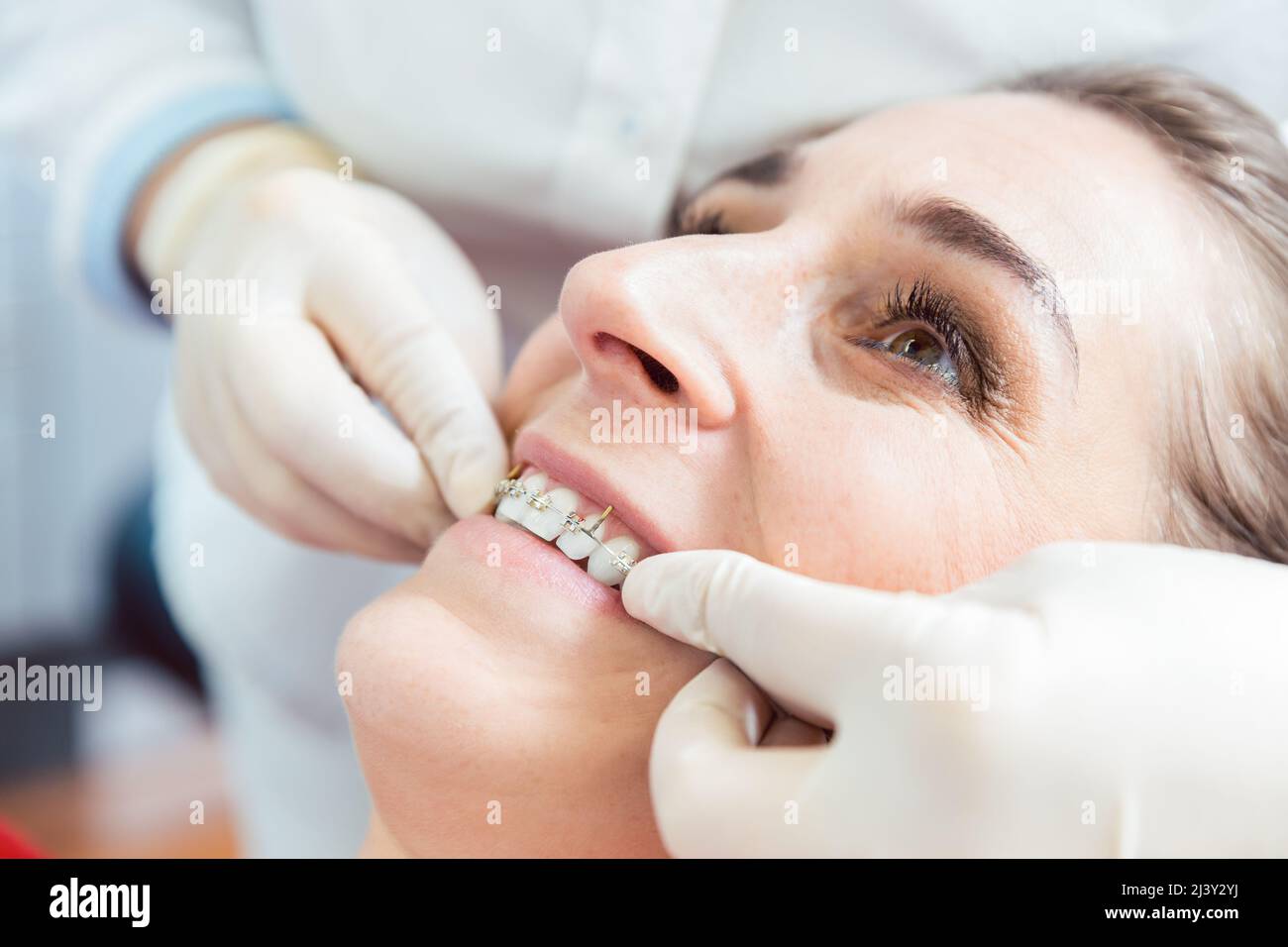 El dentista fija aparatos ortopédicos en los dientes de la mujer Foto de stock