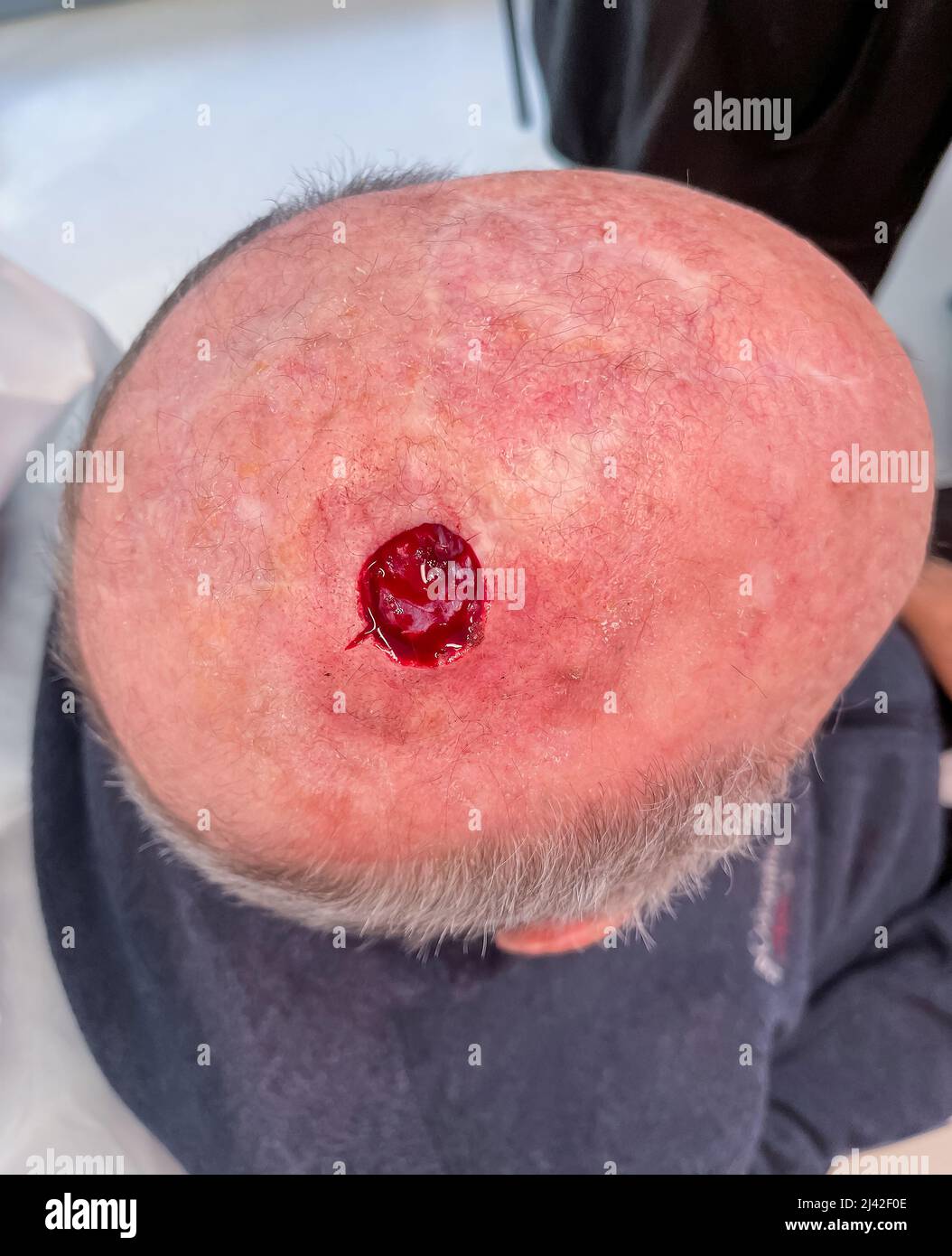 Carcinoma de células escamosas de cirugía del cuero cabelludo Foto de stock
