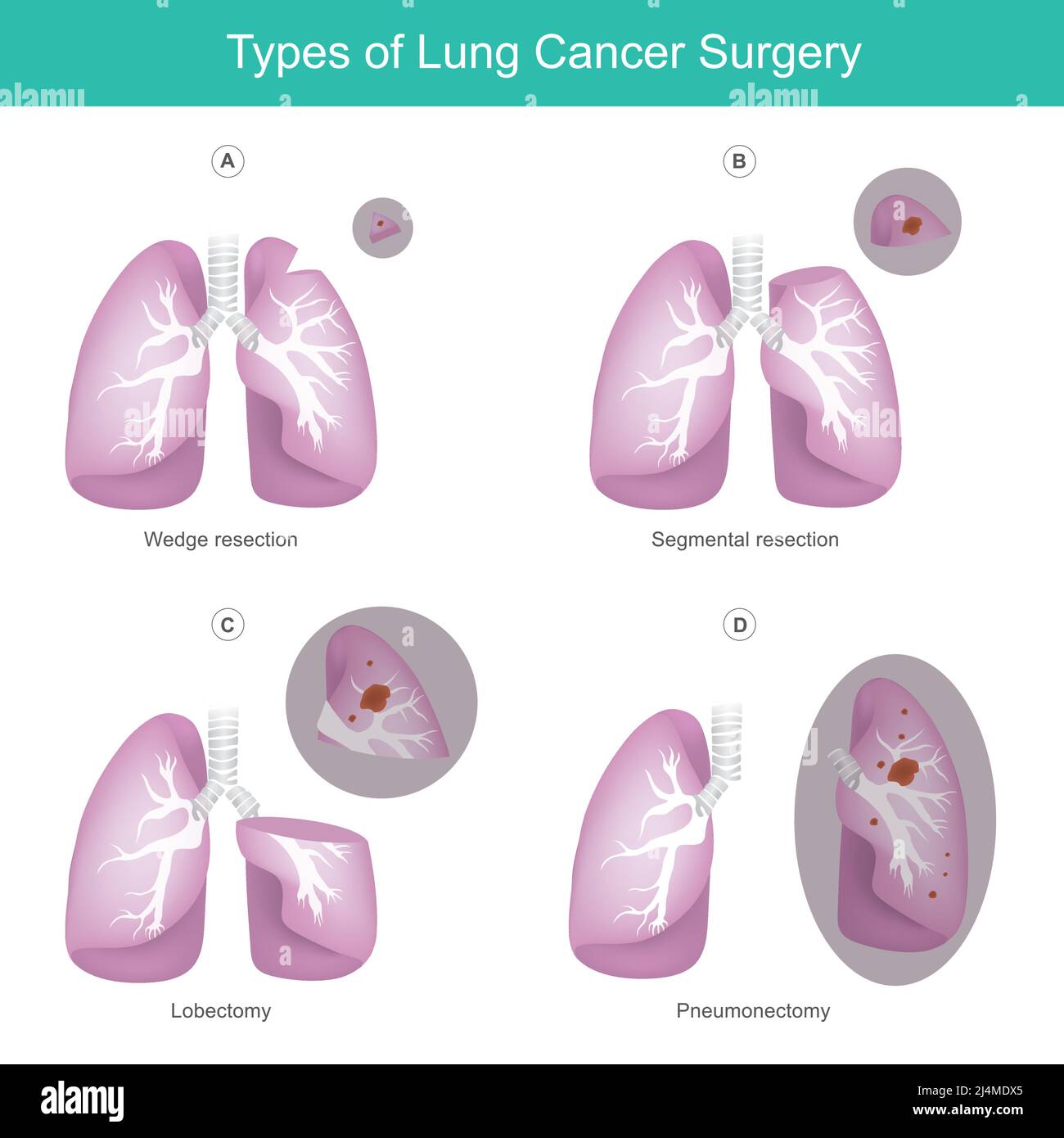 Tipos de cirugía del cáncer de pulmón. Ilustración El pulmón 4 tipos de cirugía causada por el cáncer. Ilustración del Vector