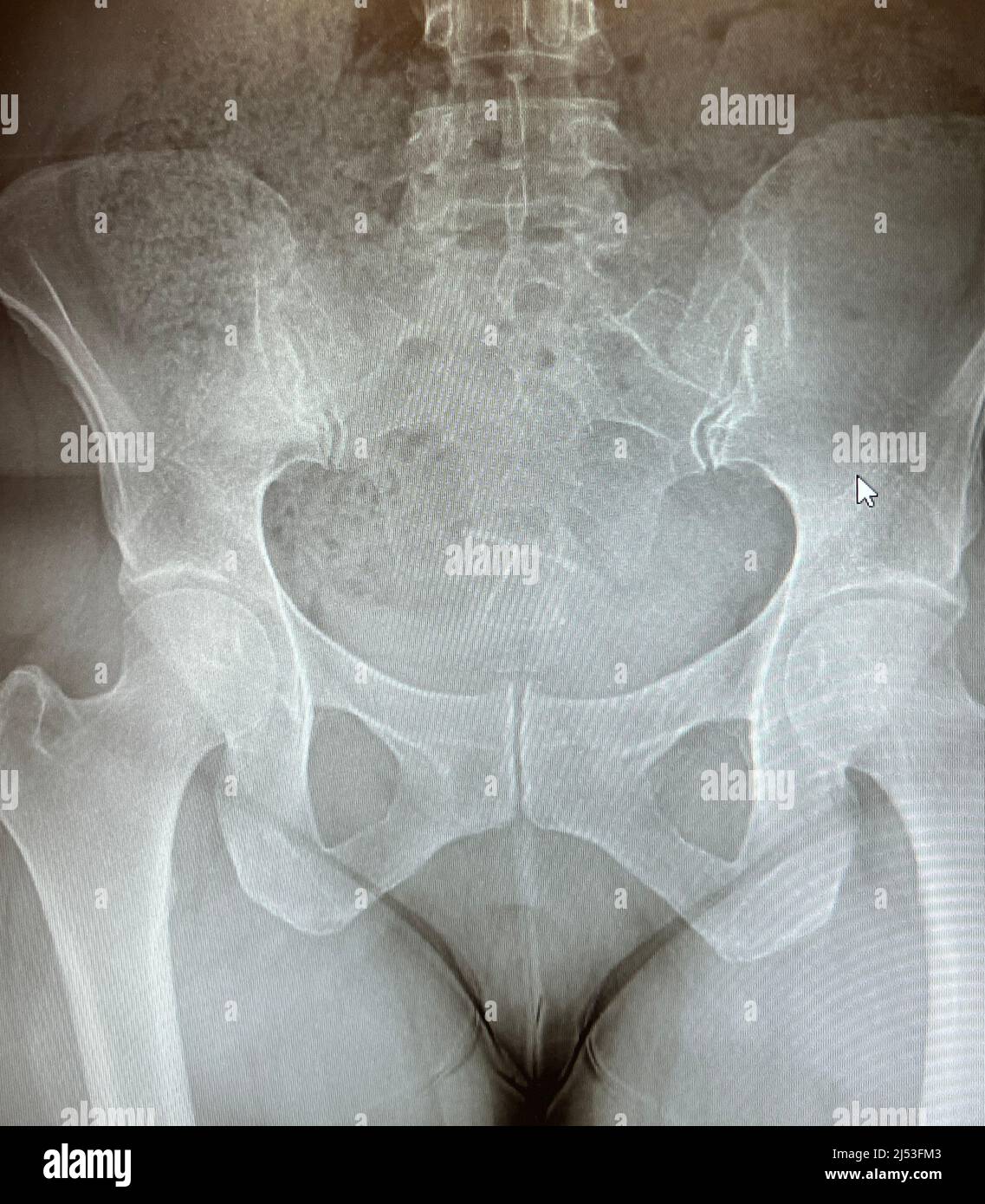 Radiografía de las caderas de una mujer de mediana edad Foto de stock