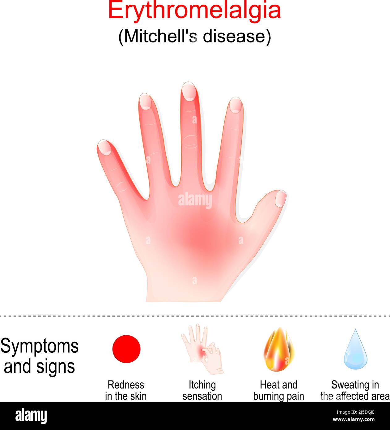 La eritromelalgia es una afección poco común que causa episodios de ardor en las manos y otras partes del cuerpo. La enfermedad de Mitchell en la izquierda ha Ilustración del Vector