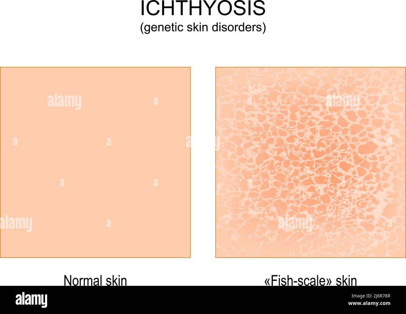 Ictiosis. Trastornos genéticos de la piel. Normal y la piel de una persona con ictiosis es áspera, seca y escamosa. piel a escala de peces. ilustración vectorial Ilustración del Vector