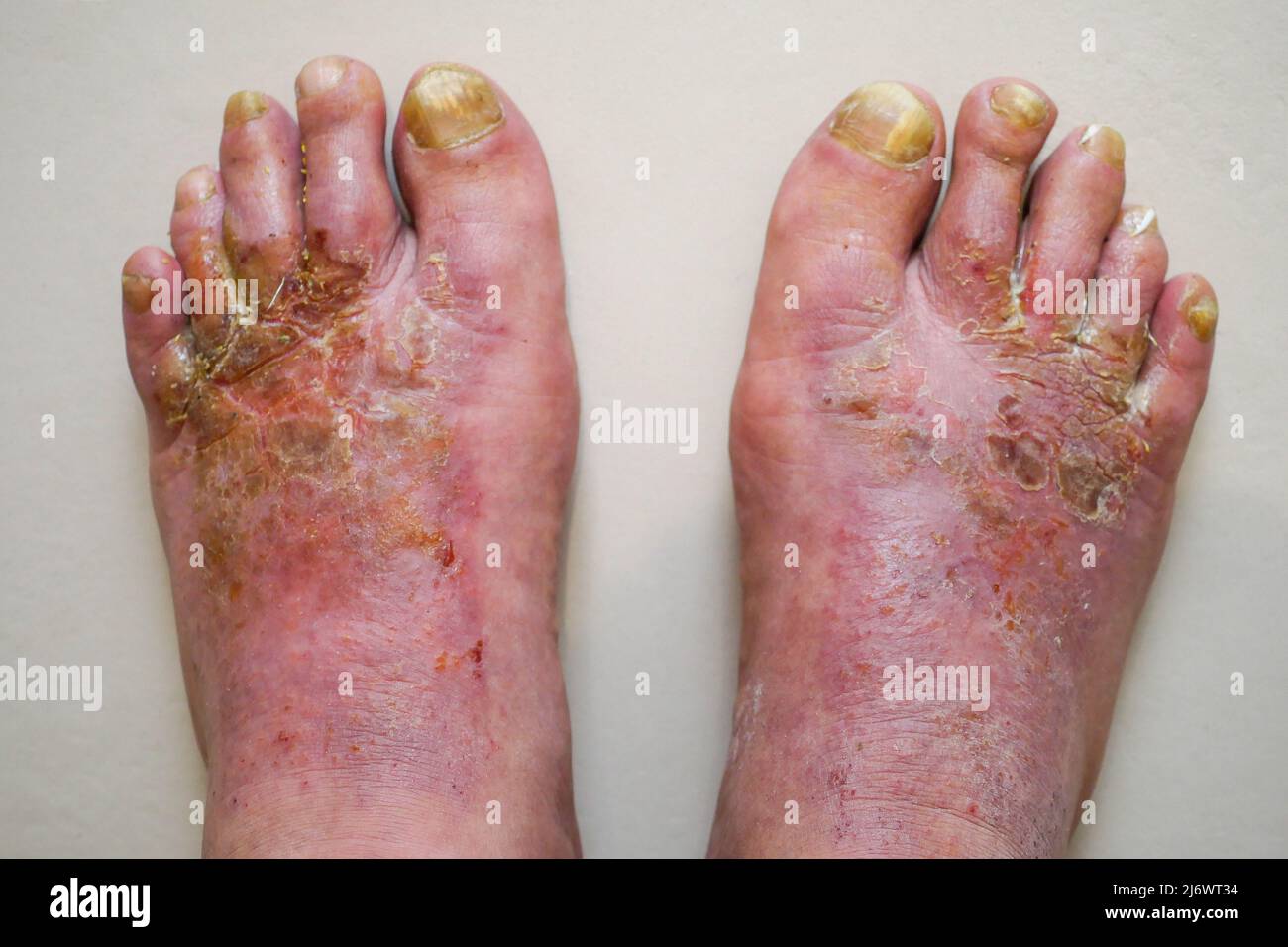 Pies del hombre afectados por la enfermedad del pie de atleta (tinea  pedis), Francia Fotografía de stock - Alamy
