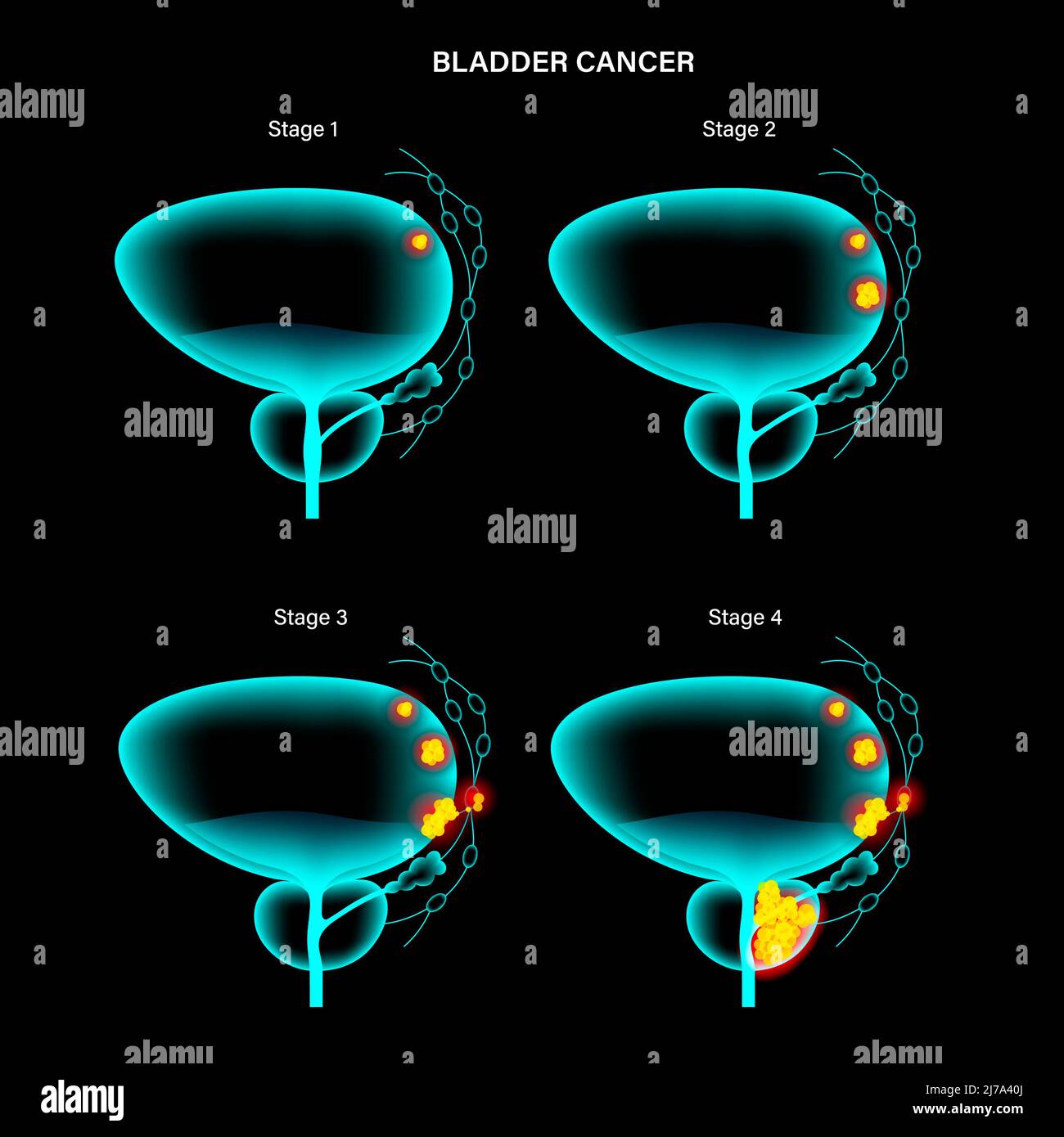 Estadios del cáncer de vejiga, ilustración Fotografía de stock Alamy Estadios del cáncer de vejiga, ilustración Fotografía de stock Alamy