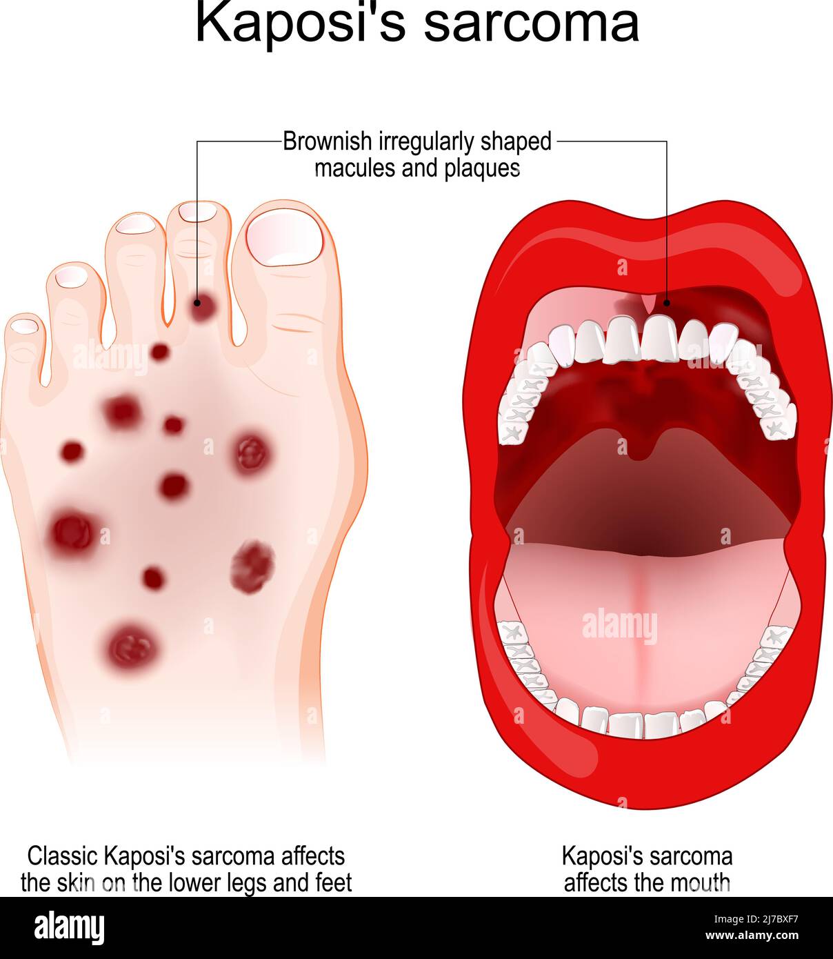 El sarcoma de Kaposi es un tipo raro de cáncer causado por una infección por el herpesvirus humano. El sarcoma de Kaposi afecta la boca y el pie. Síntoma de Kaposi Ilustración del Vector