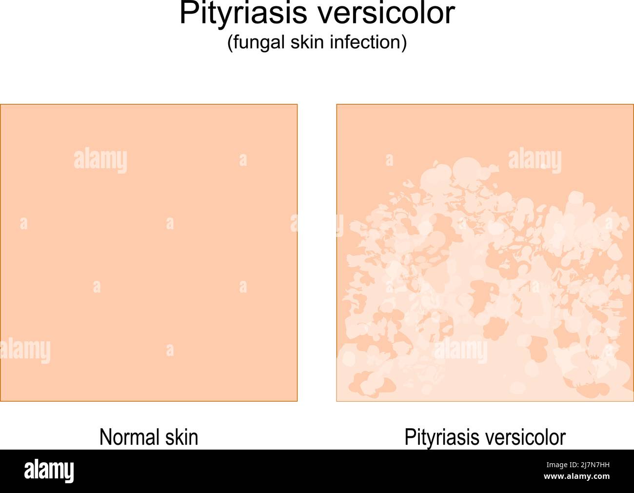 Pityriasis versicolor. Infección micótica de la piel. Comparación de piel sana y tiña versicolor. Ilustración vectorial Ilustración del Vector