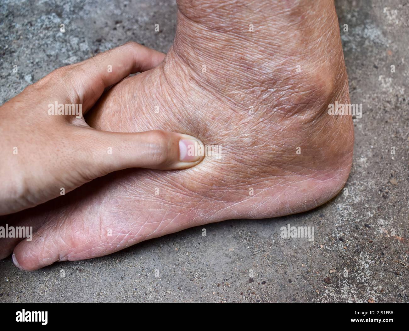 Edema de la pierna fotografías e imágenes de alta resolución - Alamy