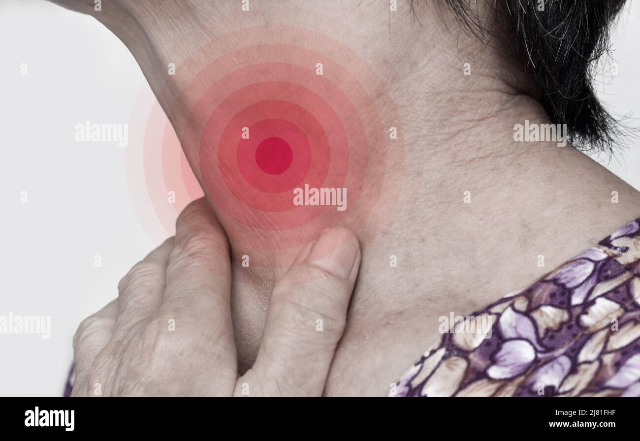 Enrojecimiento en el cuello de Asia, Myanmar hombre. Concepto de dolor de garganta, faringitis, laringitis, tiroiditis o disfagia. Foto de stock