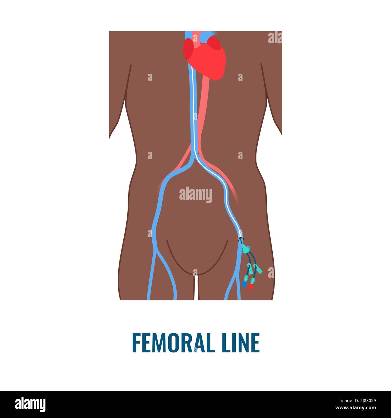 Catéter venoso central femoral, ilustración Fotografía de stock - Alamy