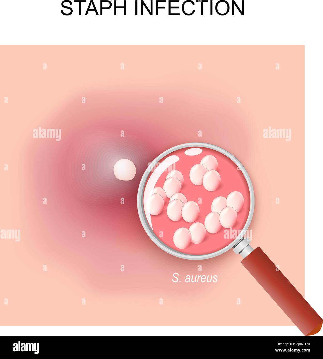 Infección por estafilococos causada por bacterias estafilococos. Primer plano de una protuberancia roja dolorosa en la piel. Acné. Staphylococcus aureus. Lupa Ilustración del Vector