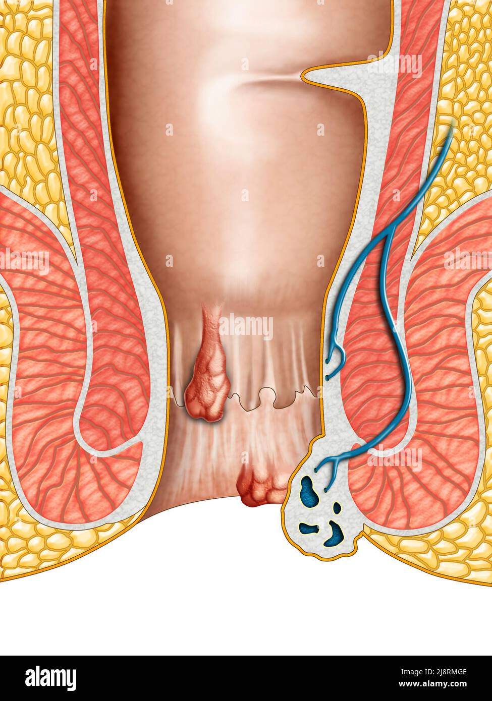 Dibujo anatómico que muestra las hemorroides internas y externas. Ilustración digital. Foto de stock