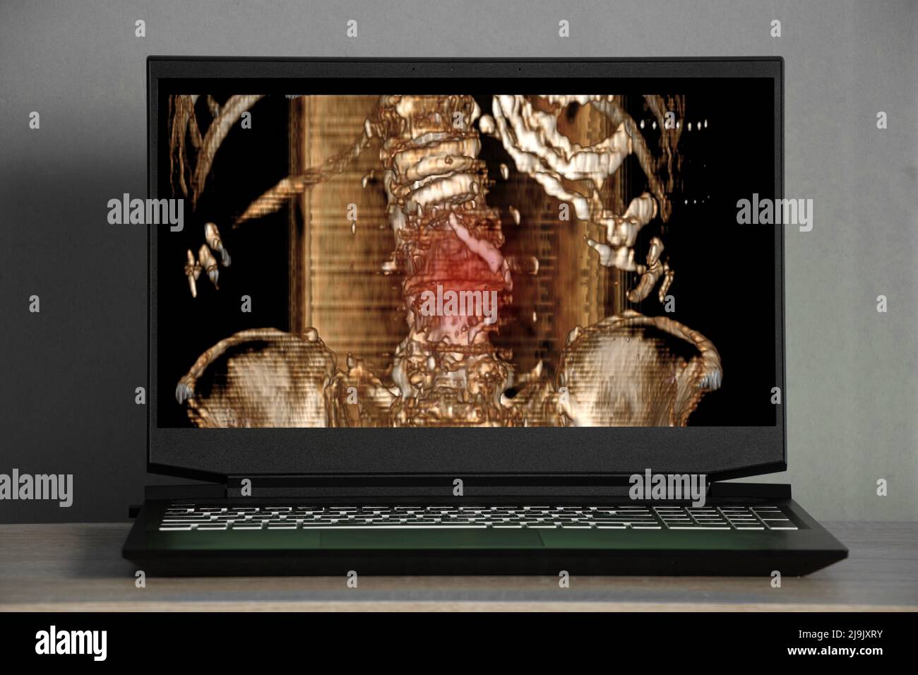 3d tomografía computarizada de la columna vertebral con una fractura después de una lesión en las pantallas del ordenador portátil de la mesa, la columna vertebral después de una caída se rompe Foto de stock