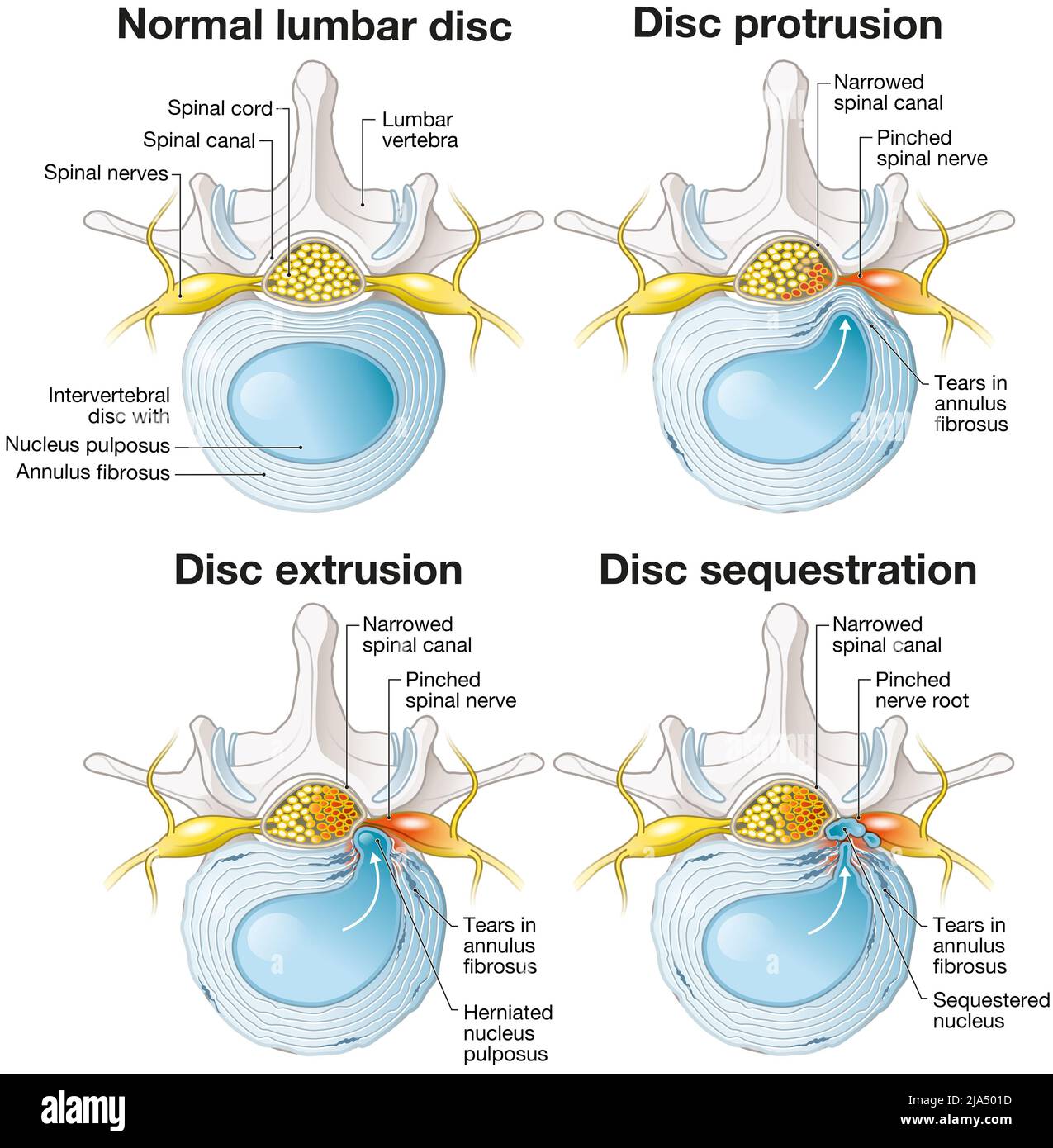 Lumbar disc extrusion. colección de la La Unidad Especializada en Ortopedia  y Traumatología S.A.S www unidadortopedia c…