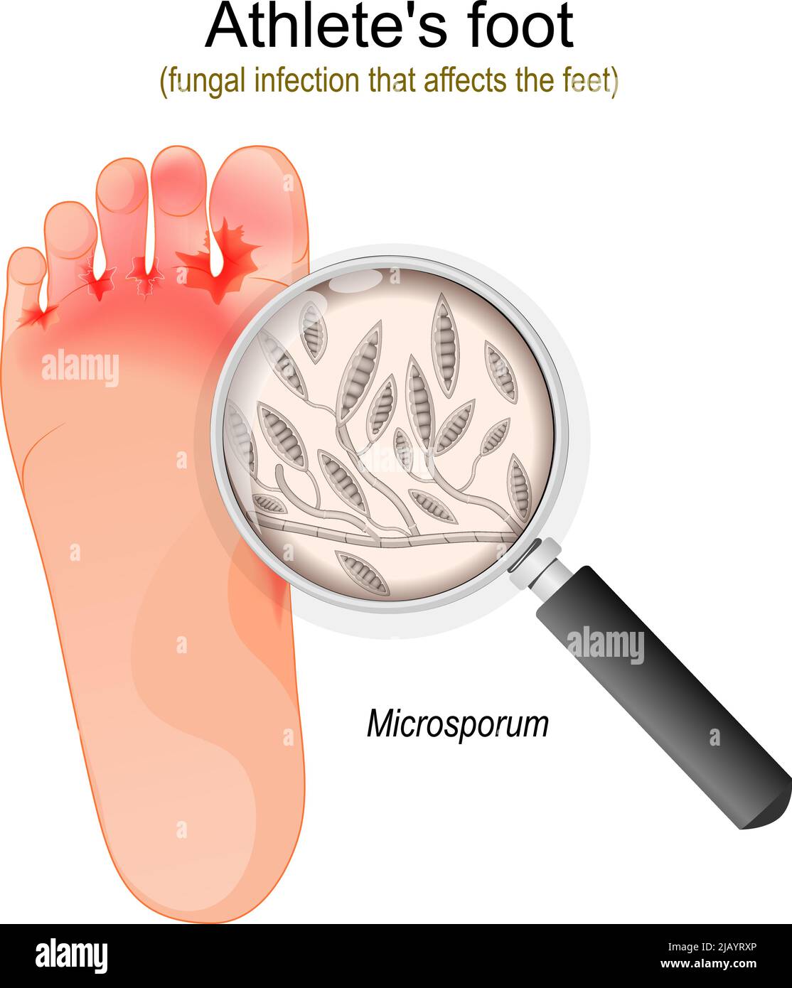 Pie de atleta. Infección micótica que afecta los pies. Primer plano de hongos Microsporum. Ilustración vectorial Ilustración del Vector