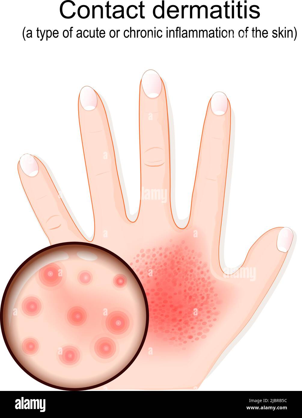 Dermatitis de contacto. Eccema atópico. Primer plano de la erupción en la mano. Piel humana con dermatitis. Penetración de alérgenos. Ilustración vectorial Ilustración del Vector