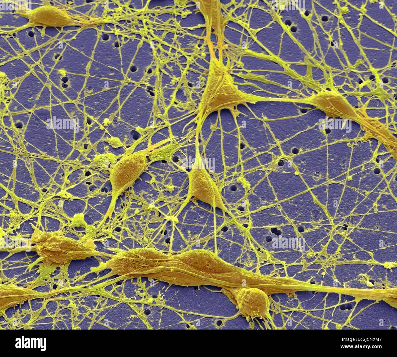 Neuronas derivadas pluripotentes. Micrografía electrónica de barrido en  color (SEM). Las neuronas humanas creadas a partir de células madre  pluripotentes inducidas (IPSCs) a través de la sobreexpresión de Neurogenin  2 (Ngn2) se