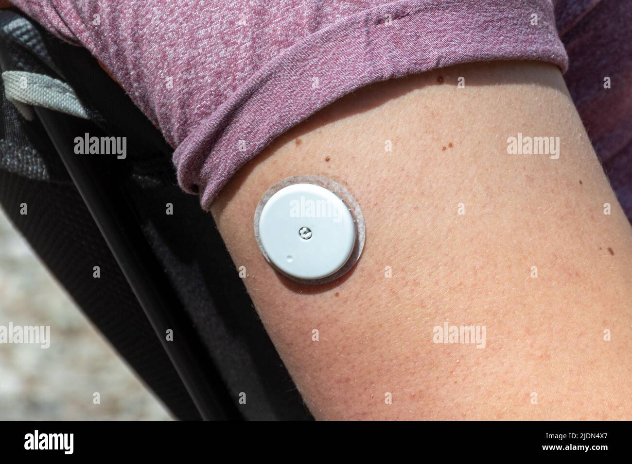 Hombre diabético joven que usa un sensor para un monitor de glucosa para verificar los niveles de azúcar en la sangre sin necesidad de un pinchazo de dedo, tratamiento moderno para la diabetes Foto de stock