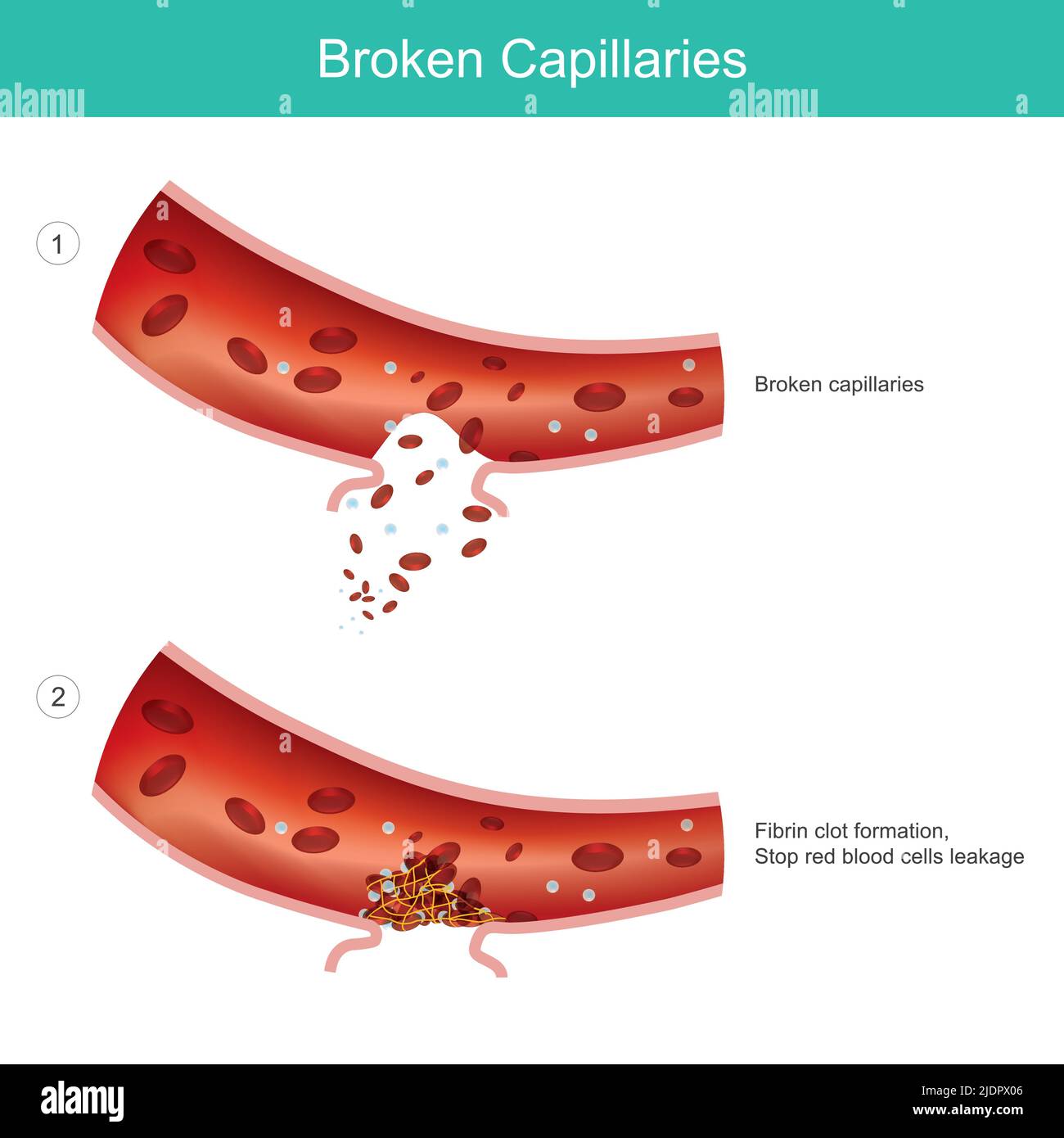 Capilares rotos. Causados por capilares sanguíneos se expanden demasiado. Ilustración del Vector