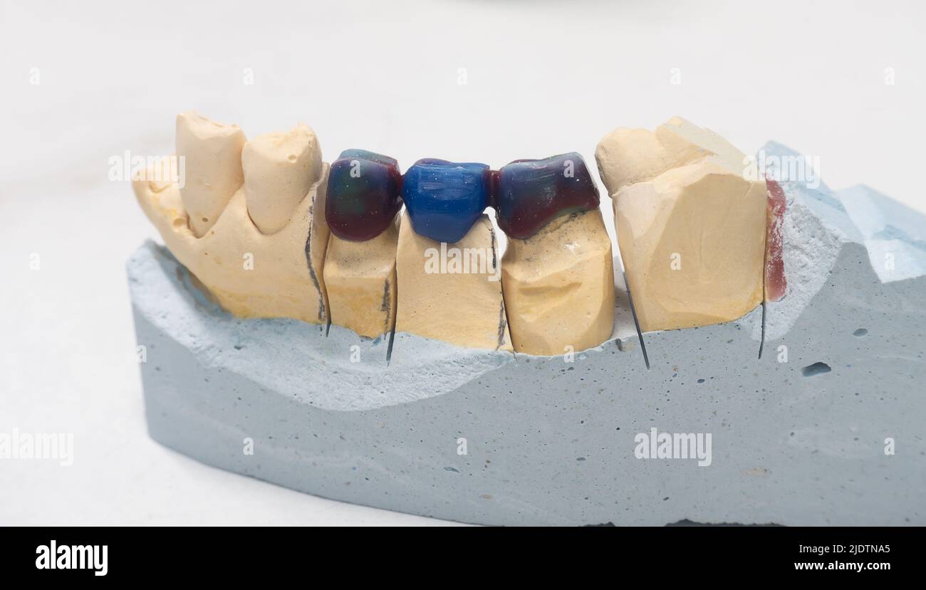 Los dientes artificiales están hechos de cera para el paciente Foto de stock
