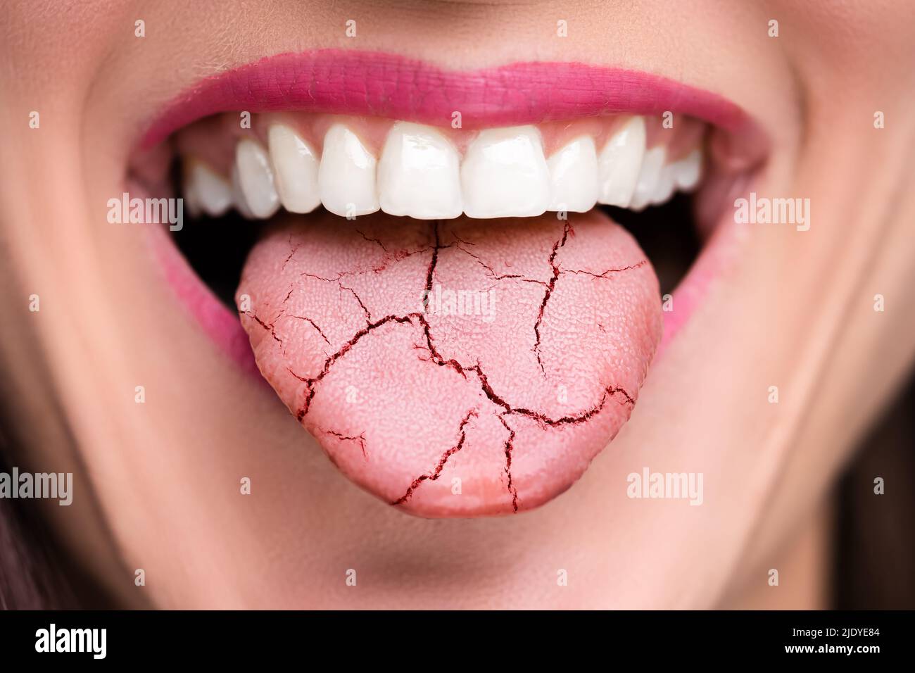 Candidiasis oral fotografías e imágenes de alta resolución - Alamy