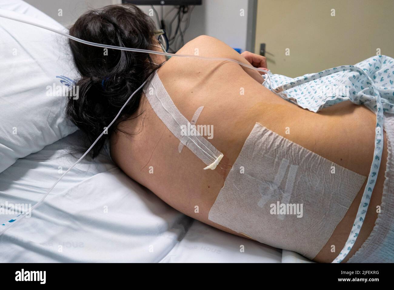 Mujer embarazada con catéter epidural lumbar resultante de la administración epidural en preparación para el trabajo de parto Foto de stock