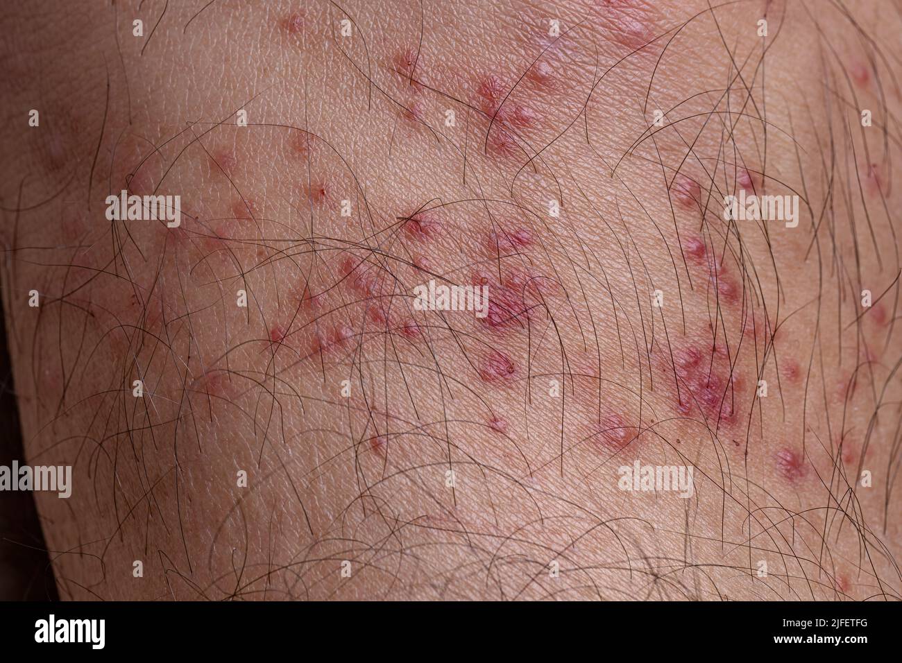 Piel humana con diversas reacciones alérgicas a las picaduras de garrapatas con enfoque selectivo Foto de stock
